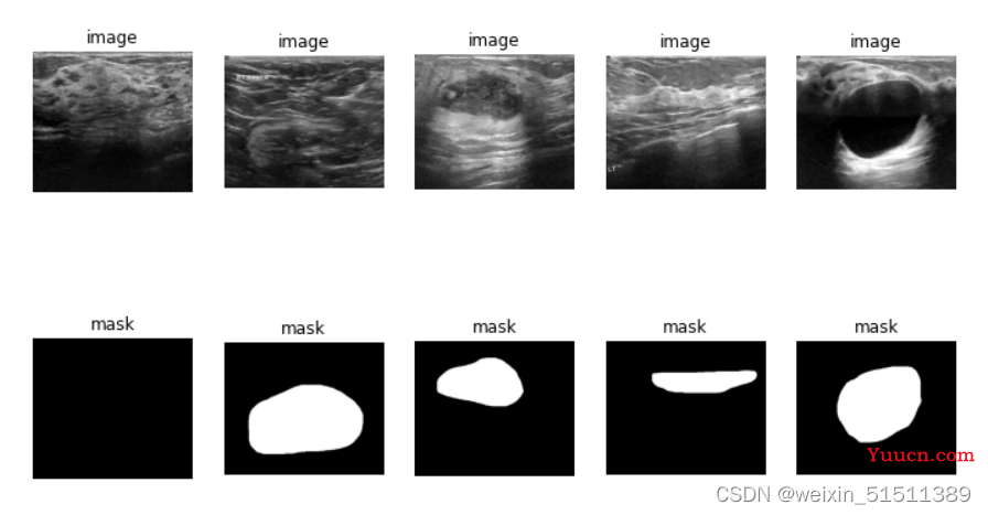 基于VGGNet乳腺超声图像数据集分析