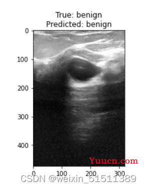 基于VGGNet乳腺超声图像数据集分析