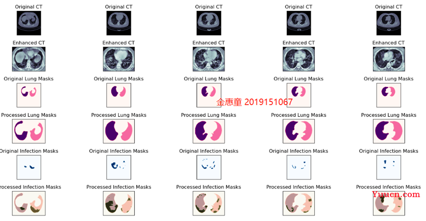 【计算机视觉】新冠肺炎COVID-19 CT影片阳性检测，感染区域分割，肺部分割，智慧医疗实践，医疗影像处理示例